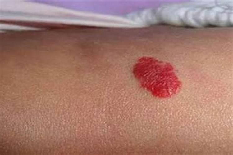 有胎记的人是童子命吗？