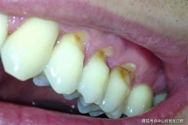 门牙有缺口婚姻不顺吗？