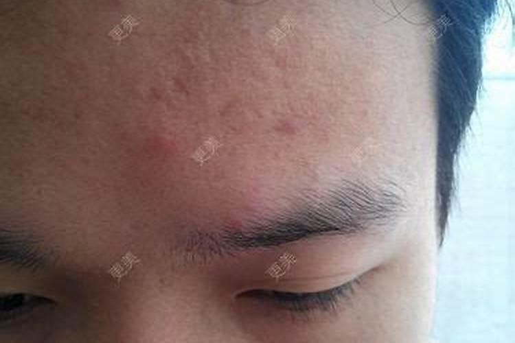印堂长痘痘是什么征兆？