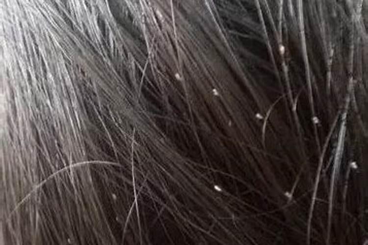 梦见头上有虱子并挤死是什么意思？