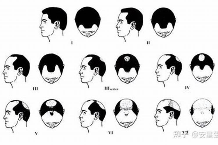 梦见发际线后移秃了