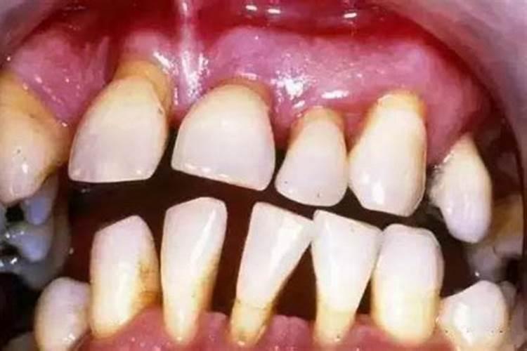 经常梦到牙齿松动脱落怎么回事？