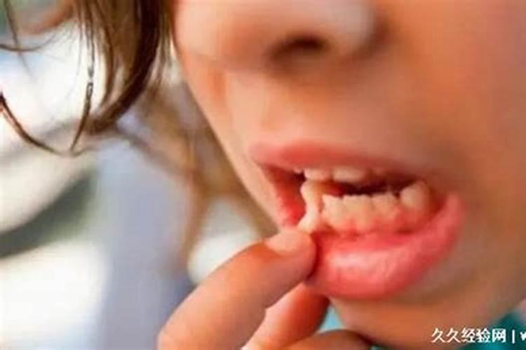 怀孕的人梦见牙齿掉