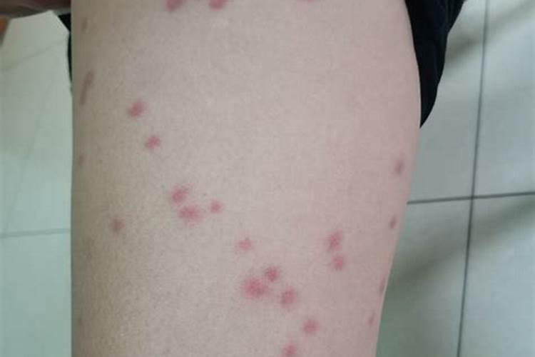 梦到自己爱的人身上起疙瘩