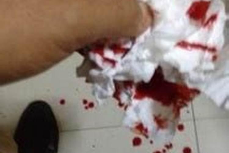 梦见手流血是怎么回事儿？