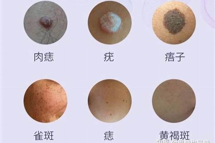 童子命身上的痣有白色的吗？