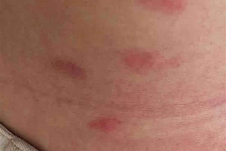 梦见老婆身上长红疙瘩