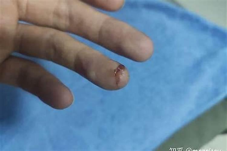 梦见手划伤了是什么意思？