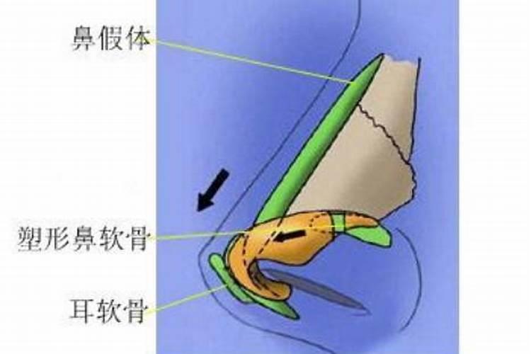 谁隆鼻了会婚姻不顺吗？