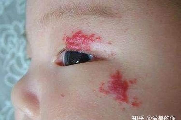 胎记真的会影响运势吗？